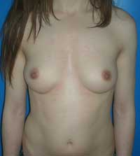 Увеличение груди