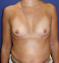 Пластика груди