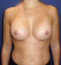 Пластика груди