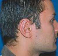 πλαστική αυτιών