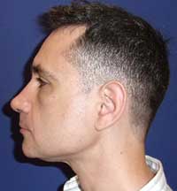 Ментопластика