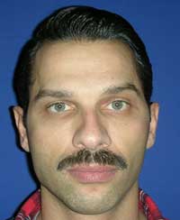 Имплантаты лица