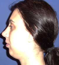 chin plasty