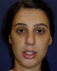 plastic surger on chin