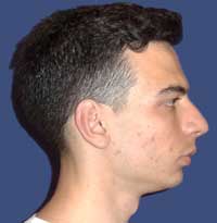 Гениопластика