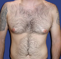 Гинекомастия 