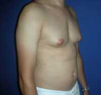 Гинекомастия 