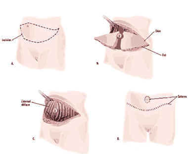 Κοιλιοπλαστική