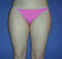 Липосакция