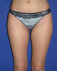 Липоскульптура