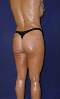 buttock augmentation