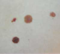 Диспластический невус