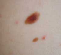 Смешанный невус