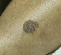 Σμηγματορροική Υπερκεράτωση