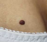 Хорионический невус