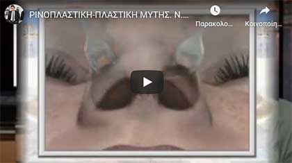 РИНОПЛАСТИКА – ПЛАСТИКА ПЕРЕГОРОДКИ НОСА