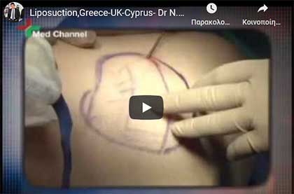 Липосакция