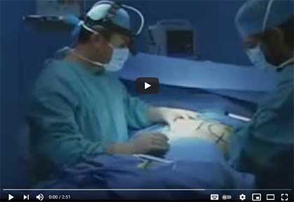 Увеличение груди