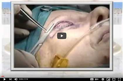 БЛЕФАРОПЛАСТИКА